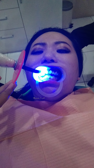 Teeth scaling and whitening for a perfect teeth. The Clinic Tanjung Duren for beauty and dental treatment.